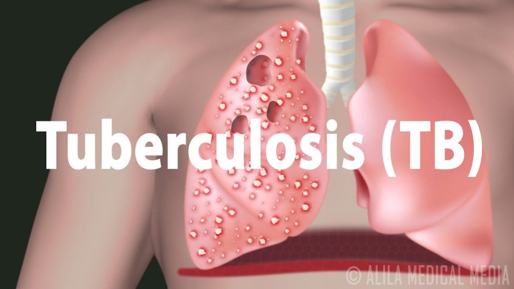 International Community Marks World Tuberculosis Day Today